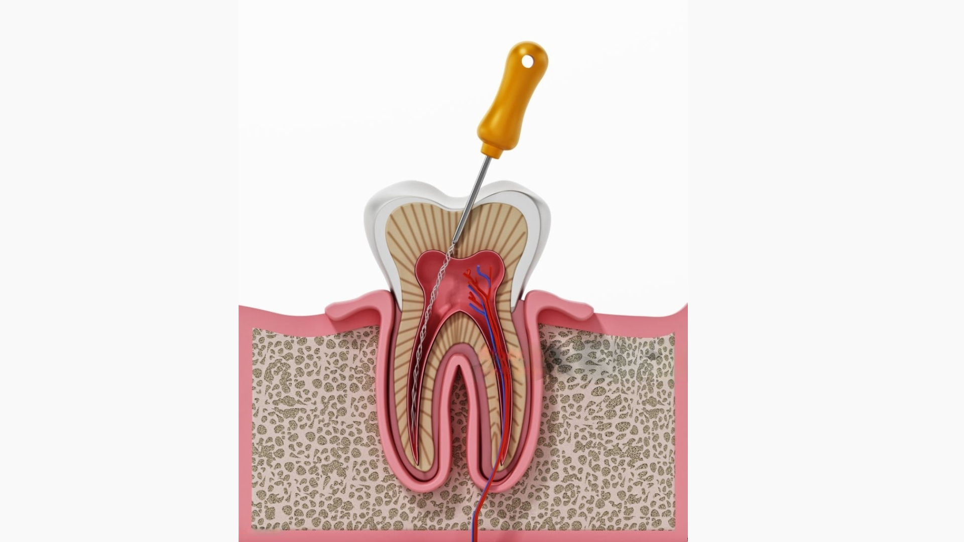 Root canal treatment in coimbatore